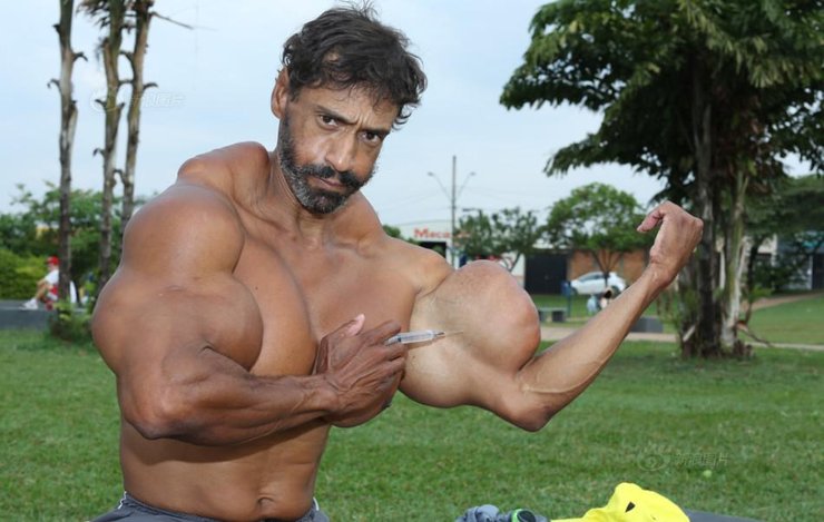 巴西男子为健身疯狂注射燃油 手臂60cm粗
